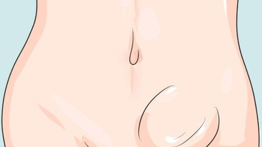 Thoát vị bẹn ở trẻ gái