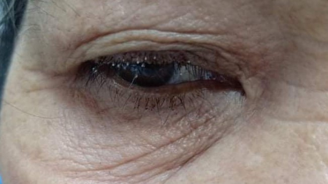 Rận mu bám trắng mi mắt