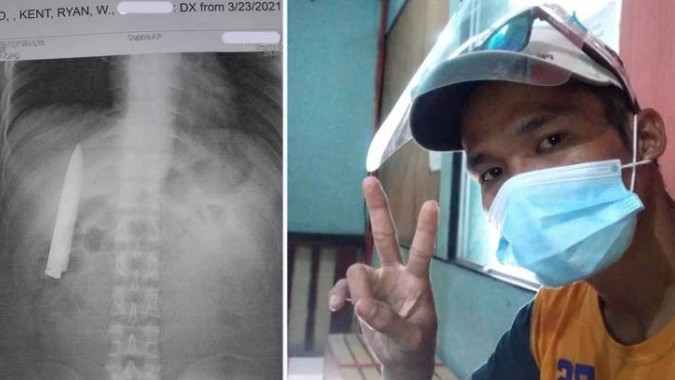 Đi khám vì tức ngực, người đàn ông sốc khi thấy lưỡi dao trong ngực