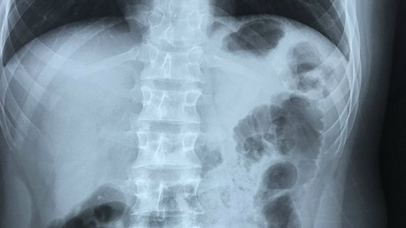 Nam thanh niên 17 tuổi có trái tim bên phải