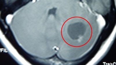 Khối u não to bằng quả quất