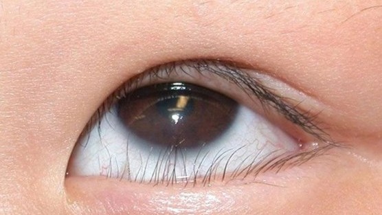 Xử lý thế nào với quặm mi bẩm sinh?