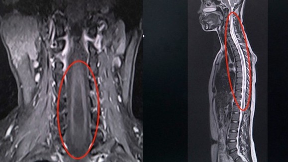 Tưởng đau cổ vai gáy, đi khám phát hiện căn bệnh có thể gây liệt tay