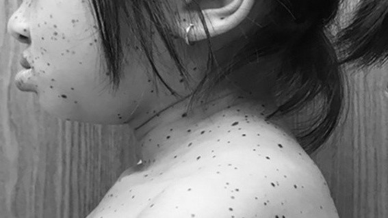 Bé gái đầu tiên ở Việt Nam mắc hội chứng da báo