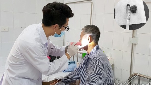 ‘Bắn’ 10 điếu thuốc lào mỗi ngày, người đàn ông mọc u lệch mặt