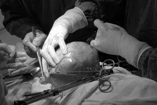 Khối u quá lớn, chèn ép nội tạng và dính vào nhiều cơ quan lân cận