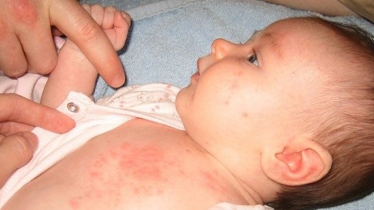 Chăm sóc trẻ mắc sốt phát ban