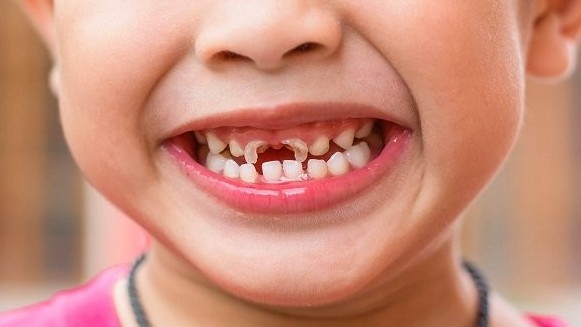 Phòng ngừa bệnh sâu răng ở trẻ em