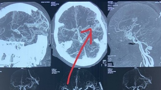 Đột quỵ tuổi 30 do dị dạng mạch máu não