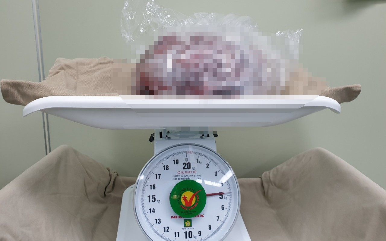 Khối u nặng 5kg của bệnh nhân.