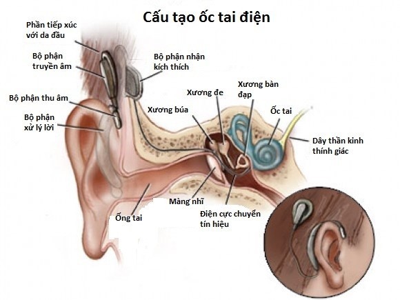 Cấu tạo ốc tai điện tử