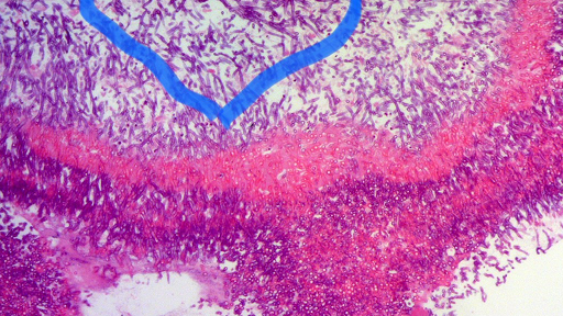 Hình ảnh nấm Aspegillus fumigatus trên tiêu bản nhuộm soi giải phẫu bệnh.