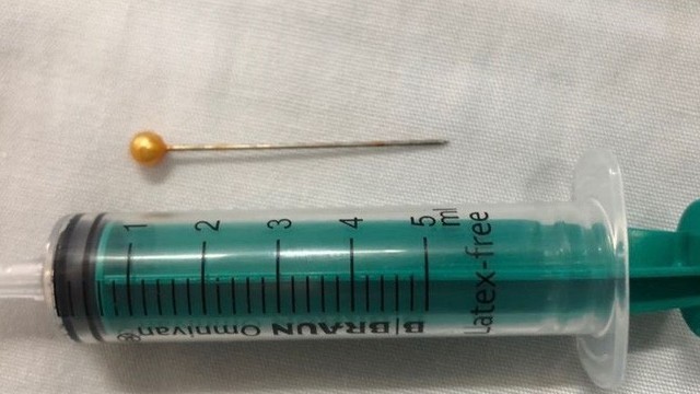 Gắp thành công cây kim sắc nhọn trong đường thở bé trai 10 tuổi