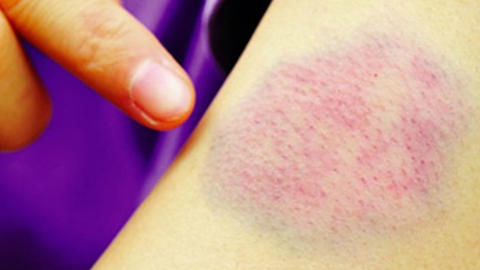 Khi thấy những mảng bầm tím xuất hiện trên da, cần đi khám ngay vì đây là dấu hiệu dễ nhận biết nhất của ung thư máu.