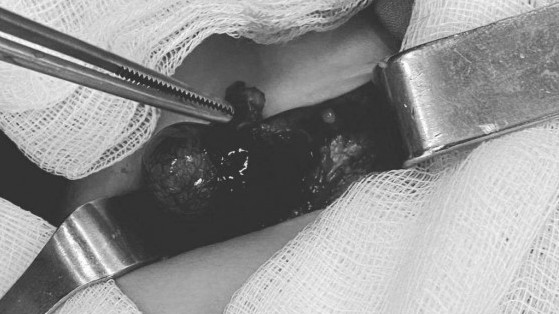 Bé trai 10 tháng tuổi phải cắt tinh hoàn do bị xoắn hoại tử