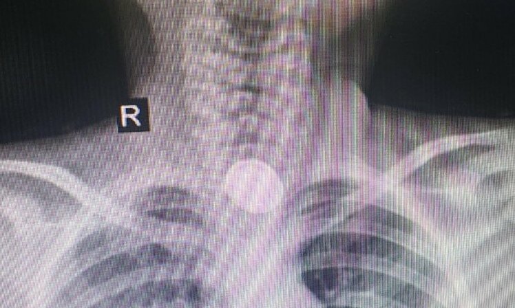 Bé gái hoại tử thực quản sau nuốt pin cúc áo