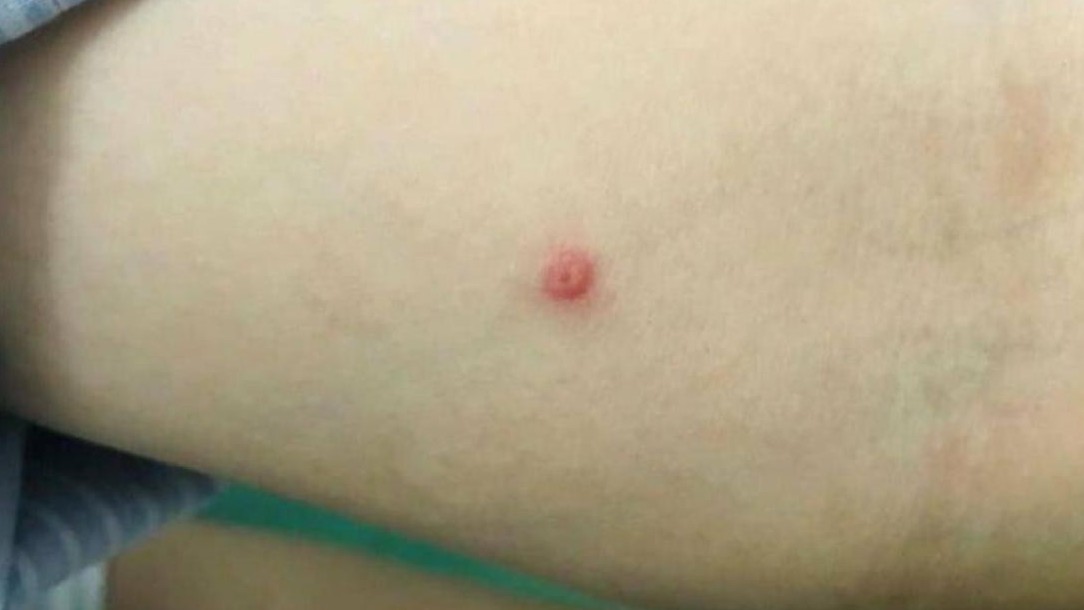 Sức khỏe nữ bệnh nhân mắc đậu mùa khỉ đầu tiên tại Việt Nam giờ ra sao?