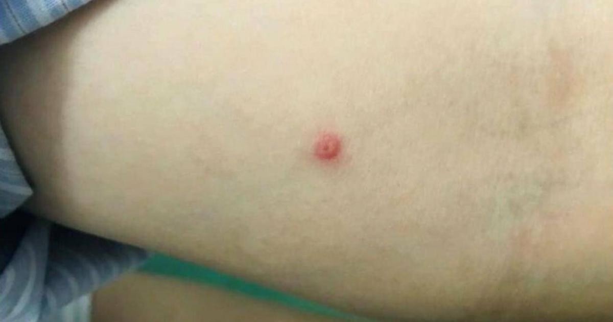 Nốt bóng nước trên cảnh tay người bệnh mắc đậu mùa khỉ