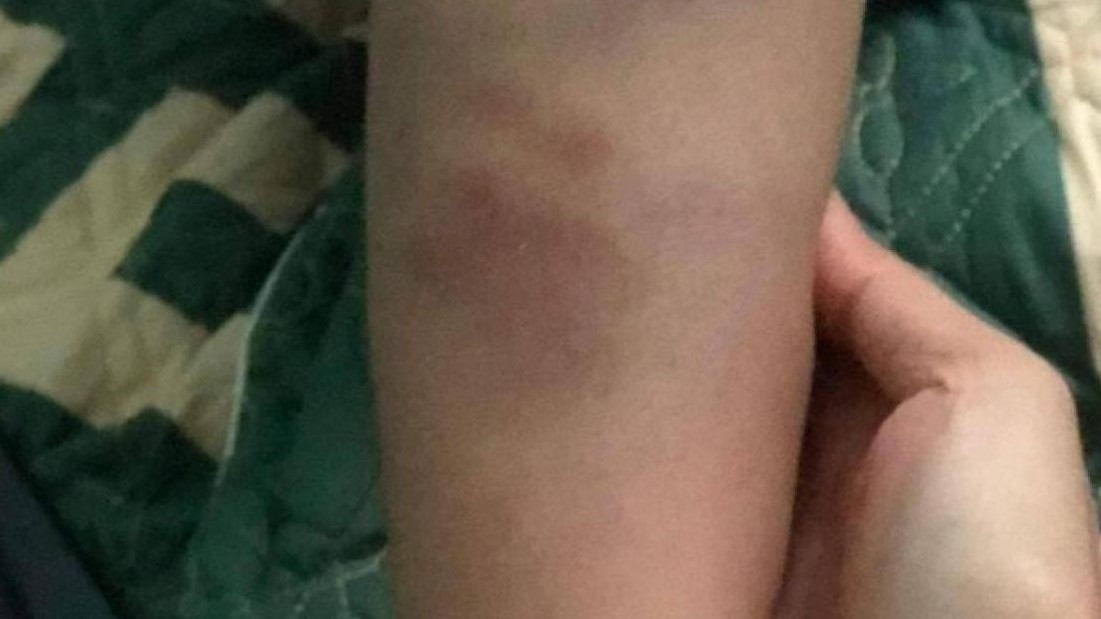 Đà Nẵng: Đang xác minh vụ học sinh lớp 1 bầm tím tay, chân sau tan trường