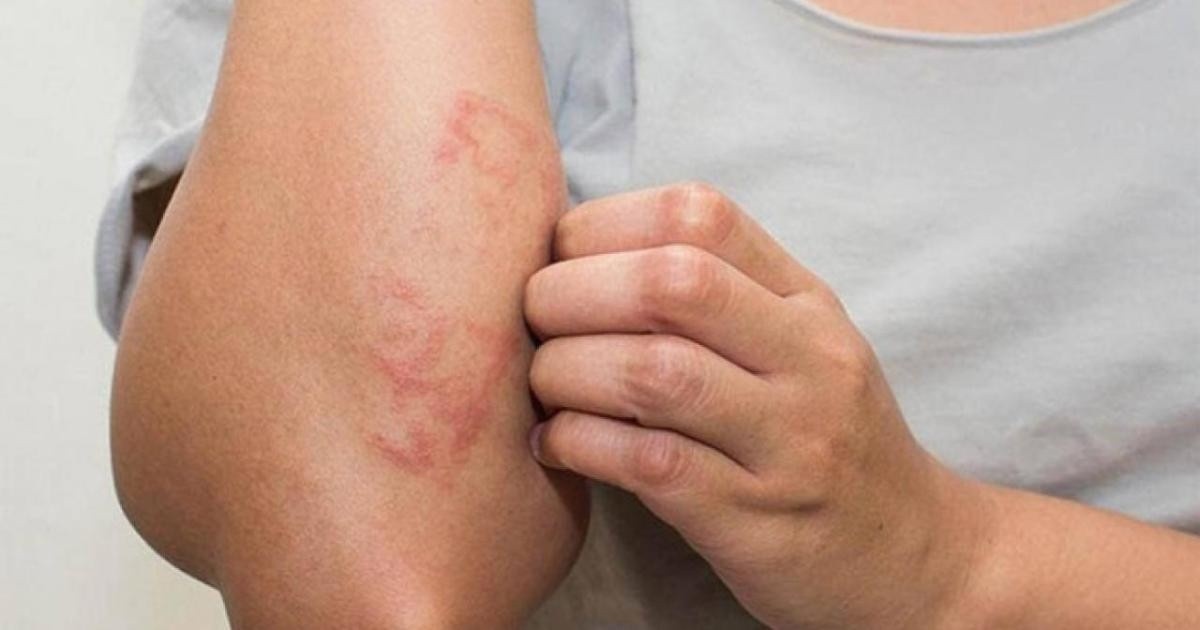 Viêm da cơ địa tăng do thời tiết chuyển mùa hanh khô