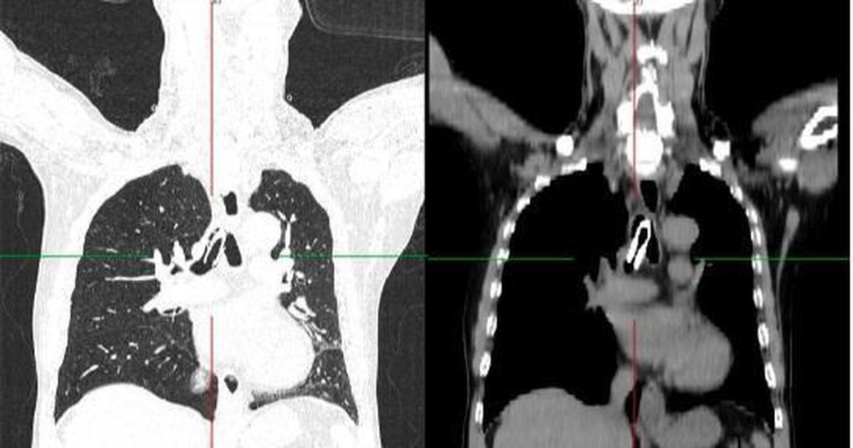 Cứu kịp thời bệnh nhân bị tắc nghẽn đường thở do gãy canyun mở khí quản