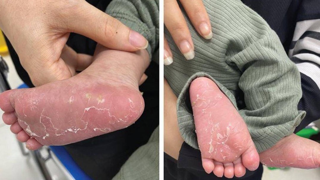 Cha mẹ ngỡ ngàng khi trẻ mắc bệnh người lớn