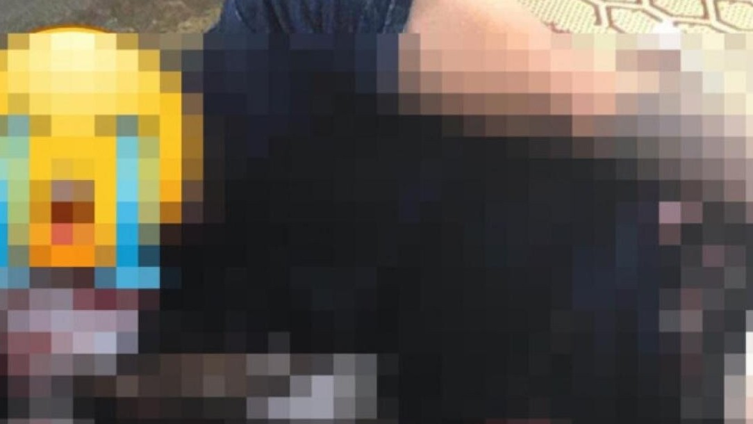 Pháo tự chế phát nổ, nam thanh niên Nghệ An dập nát bàn tay và thủng bụng