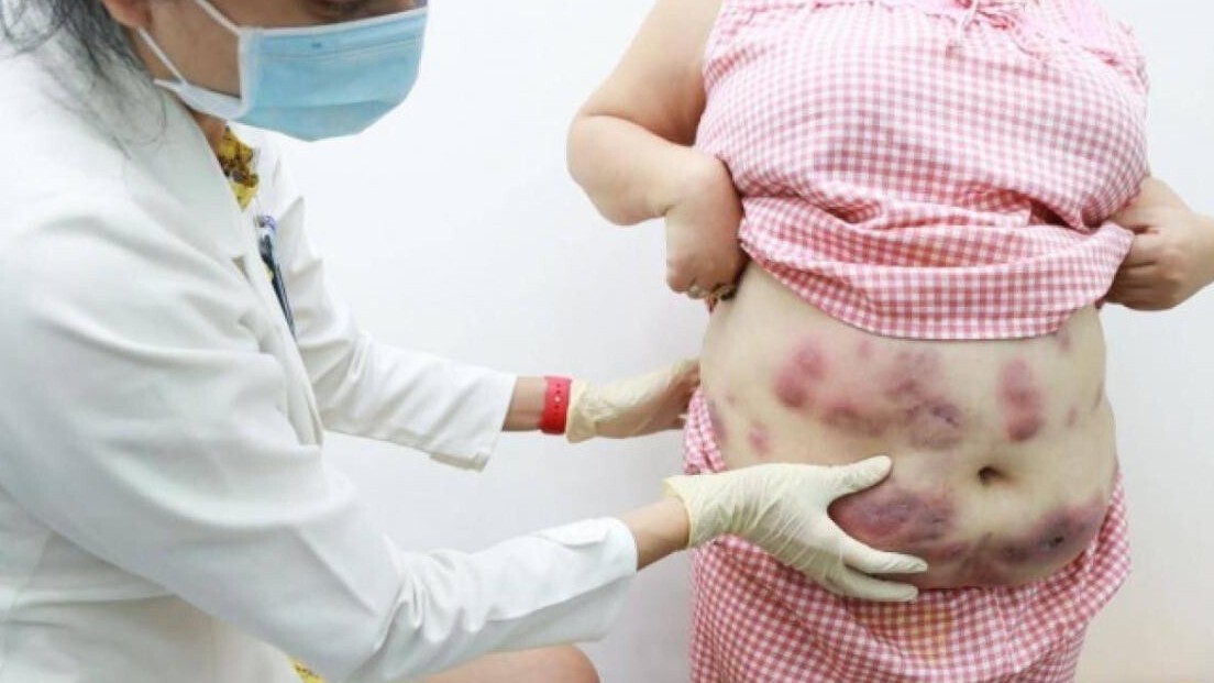 Sau tiêm tan mỡ, một phụ nữ nhập viện vì viêm đỏ, chảy mủ khắp bụng, đùi
