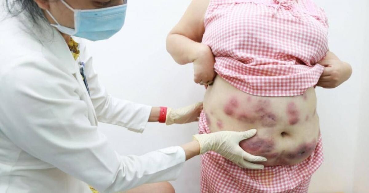 Bác sĩ thăm khám cho bệnh nhân bị áp xe viêm tấy sau tiêm tan mỡ