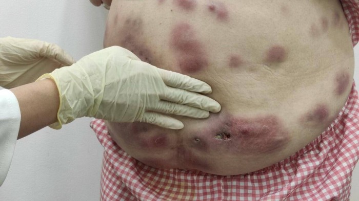 Các khối áp xe, chảy mủ trên bụng bệnh nhân