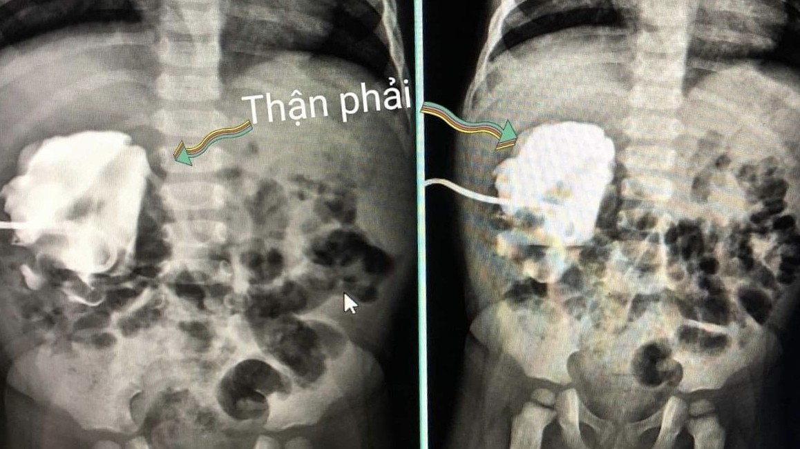 Bé trai 4 tuổi chỉ có một quả thận do mắc bệnh hiếm