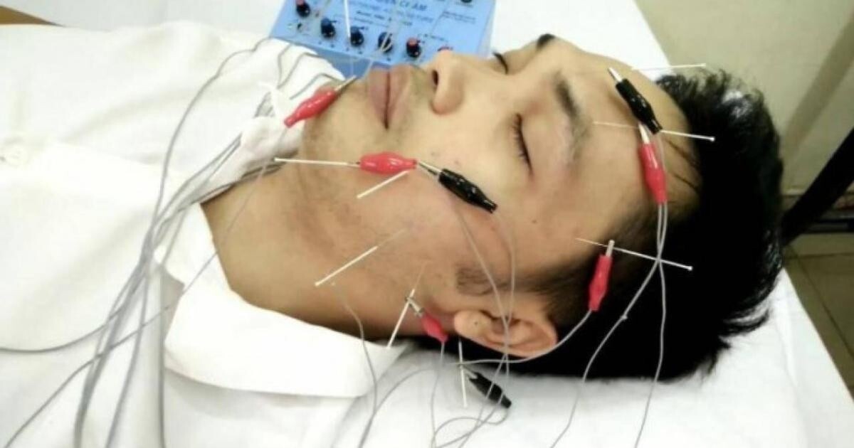 Điện châm chữa liệt dây thần kinh số 7