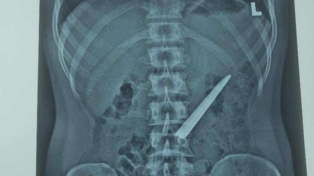 Nam thanh niên ở Bạc Liêu nuốt lưỡi dao Thái Lan vào bụng, không thủng ruột