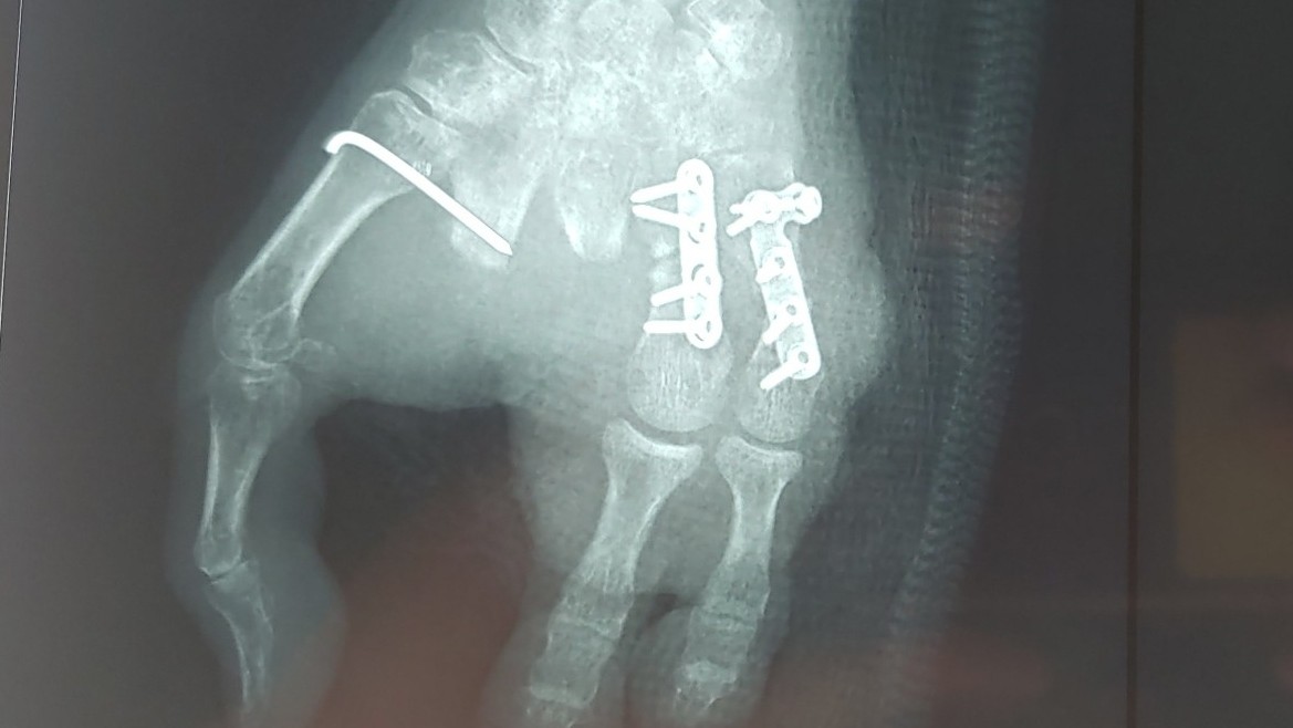 Lấy ngón chân ghép thành ngón tay cho người phụ nữ