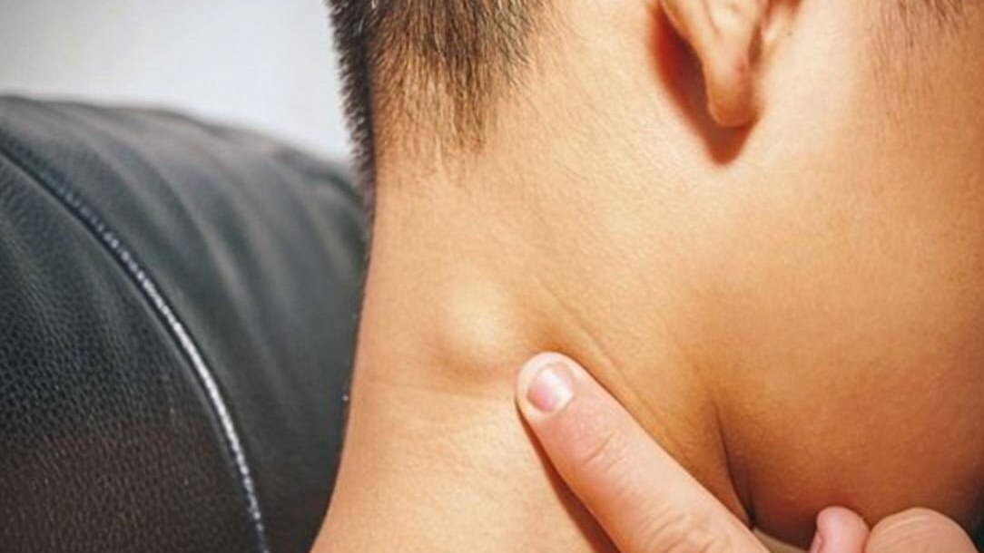 Nổi hạch ở cổ có đáng lo?