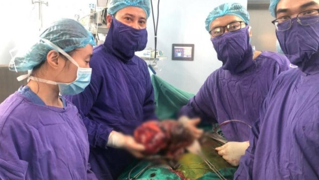 Tiểu máu, đau vùng thắt lưng, một phụ nữ mang khối u thận khủng nặng 2,8kg