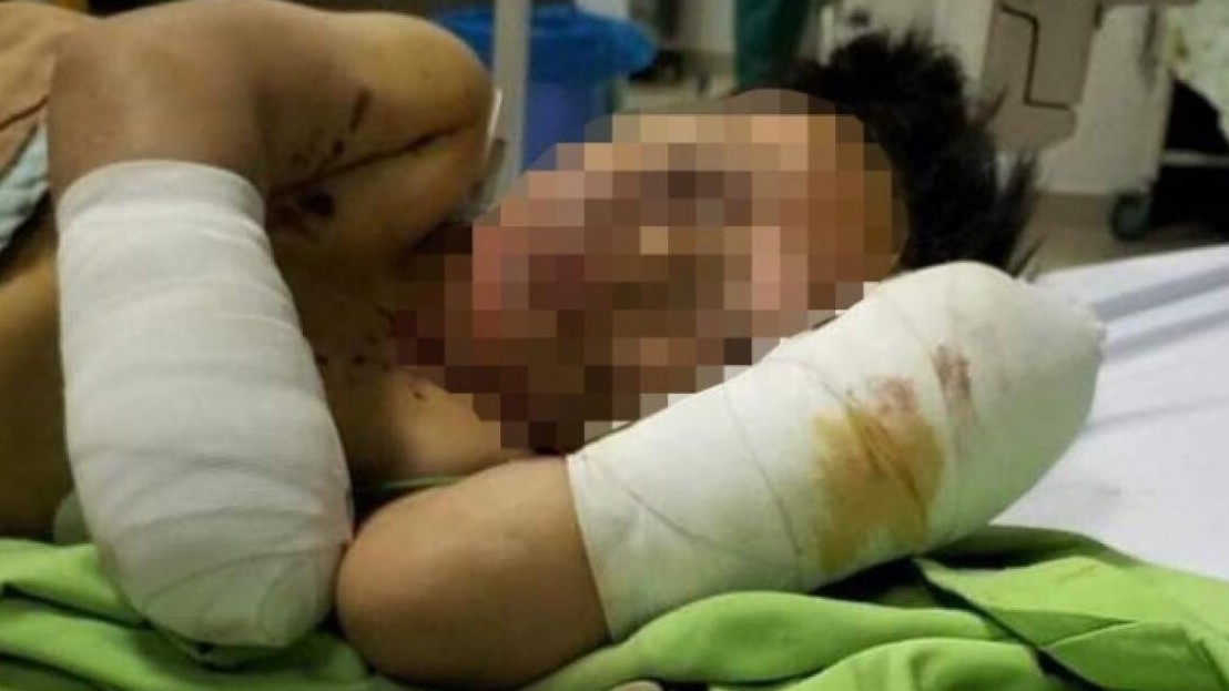 Vật lạ phát nổ khi 2 anh em đang chơi, một bé bị cụt hai bàn tay