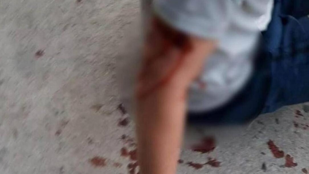 Sức khỏe du khách nước ngoài bị chó dữ cắn ở Nha Trang hiện ra sao?