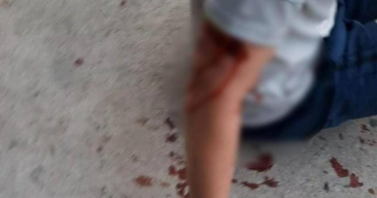 Du khách nước ngoài bị chó cắn bị thương ở cánh tay