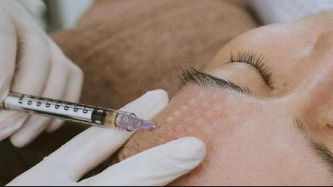 Nổi mụn li ti, u hạt sau tiêm meso vi điểm căng bóng da mặt