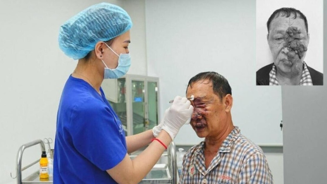 Tìm lại khuôn mặt cho cụ ông mang khối u lớn như "chùm nho" suốt nhiều năm