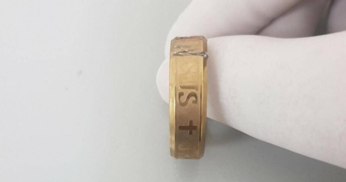 Chiếc nhẫn sau khi được lấy ra.