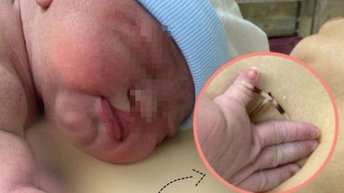 Bé gái ở Vĩnh Long chào đời cùng vòng tránh thai của mẹ