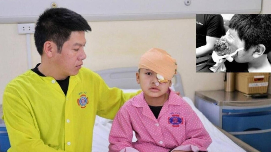 Xót xa bé trai 4 tuổi bị u “quái” khủng đẩy mắt lồi ra phía trước