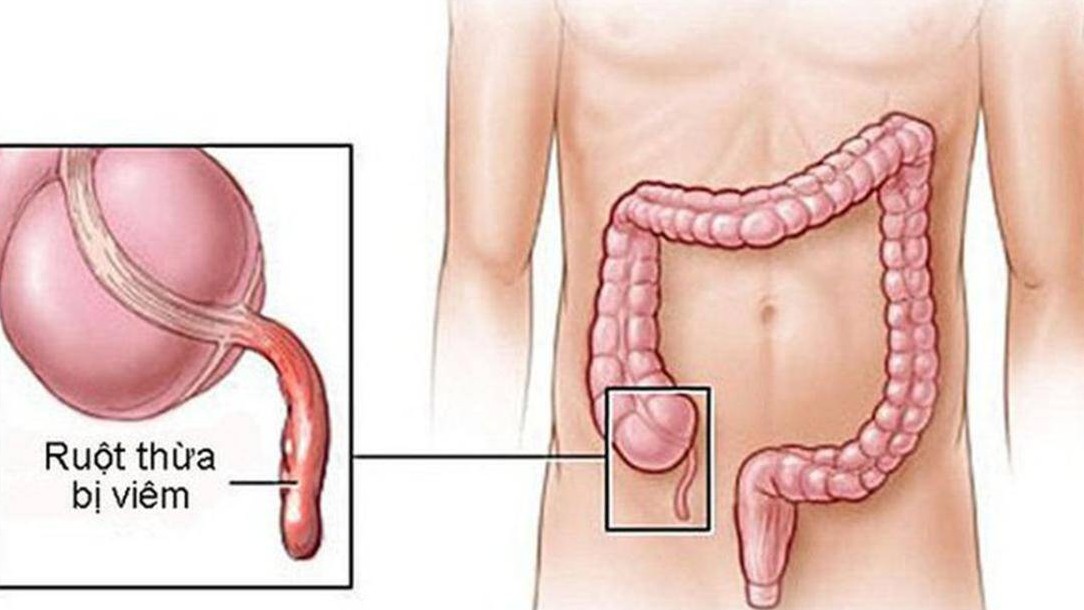 Dấu hiệu nào nhận biết viêm ruột thừa?