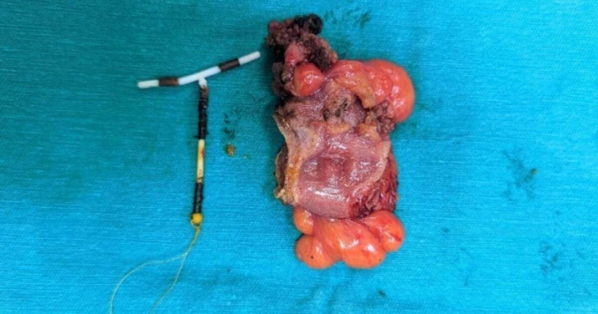 Các bác sĩ phẩu thuật lấy ra dụng cụ tránh thai đi lạc chỗ đâm thủng đại tràng (Ảnh: BVCC)