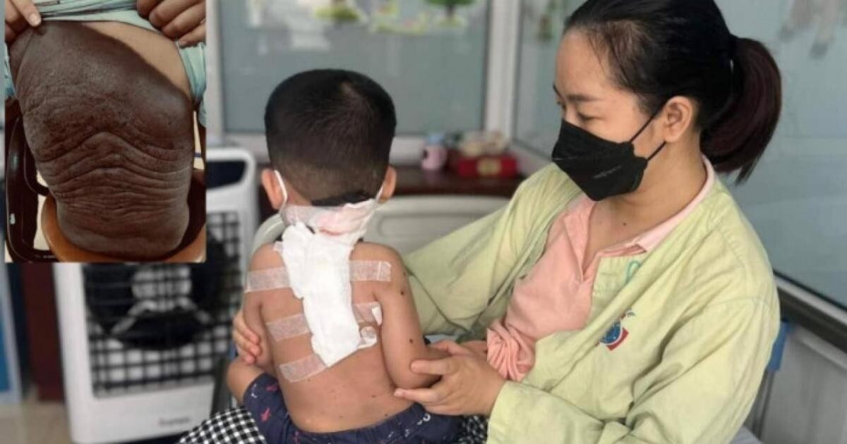 Trẻ bị nơvi hắc tố khổng lồ trên lưng sau phẫu thuật