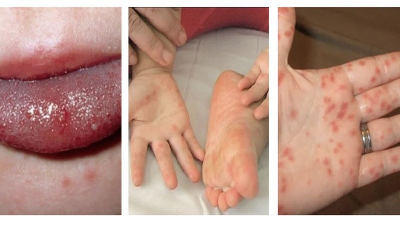 Những nốt ban do bệnh tay chân miệng có màu đỏ, sau đó tiến triển thành mụn nước vòm dày.(Ảnh minh họa)