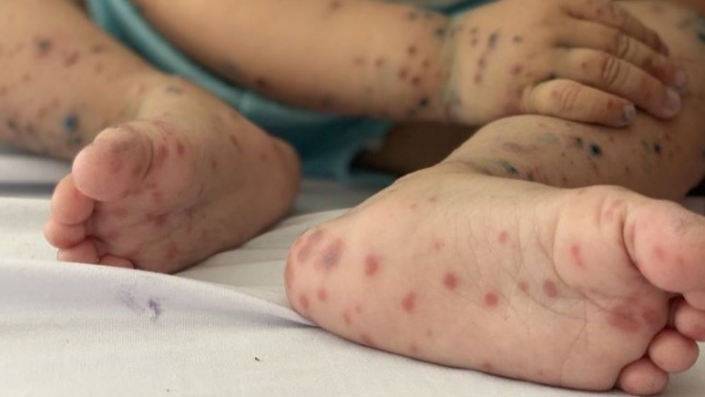 Bộ Y tế yêu cầu tăng cường theo dõi người bệnh tay chân miệng