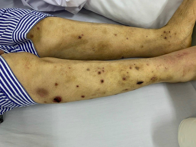 Tổn thương của bệnh nhân.